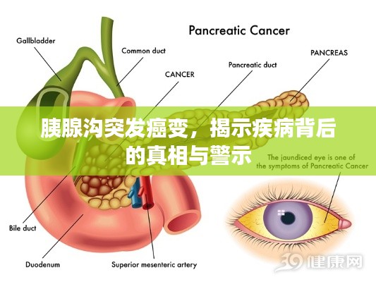 胰腺沟突发癌变，揭示疾病背后的真相与警示